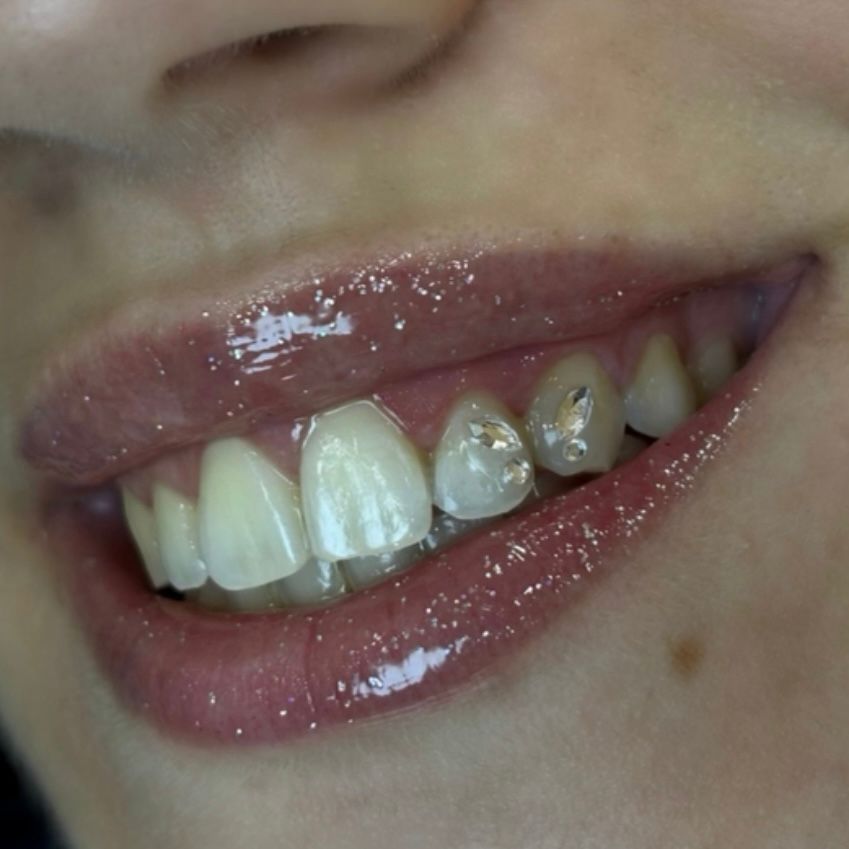 joyas-dentales-esencia-estetica-montilla-raquel-de-la-torre joyas-dentales-esencia-estetica-montilla-raquel-de-la-torre